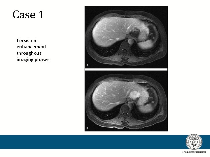 Case 1 Persistent enhancement throughout imaging phases 