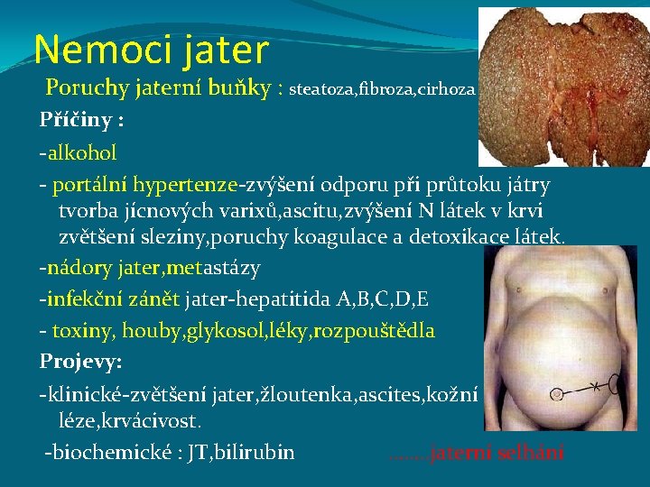 Nemoci jater Poruchy jaterní buňky : steatoza, fibroza, cirhoza Příčiny : -alkohol - portální