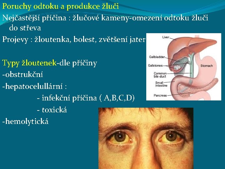 Poruchy odtoku a produkce žluči Nejčastější příčina : žlučové kameny-omezení odtoku žluči do střeva