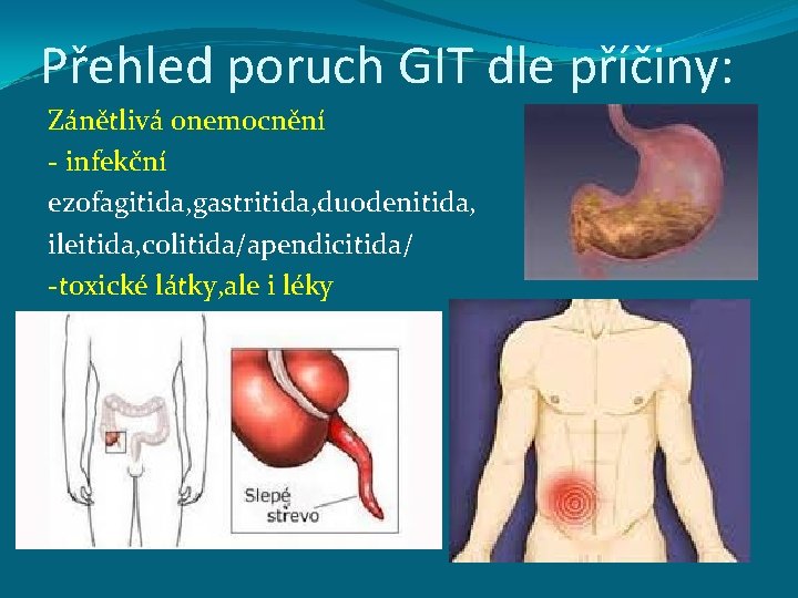 Přehled poruch GIT dle příčiny: Zánětlivá onemocnění - infekční ezofagitida, gastritida, duodenitida, ileitida, colitida/apendicitida/