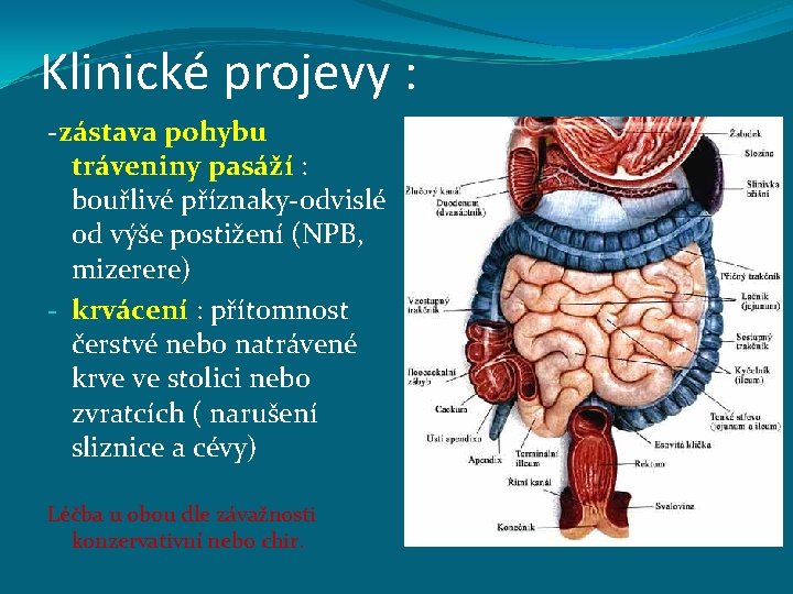 Klinické projevy : -zástava pohybu tráveniny pasáží : bouřlivé příznaky-odvislé od výše postižení (NPB,