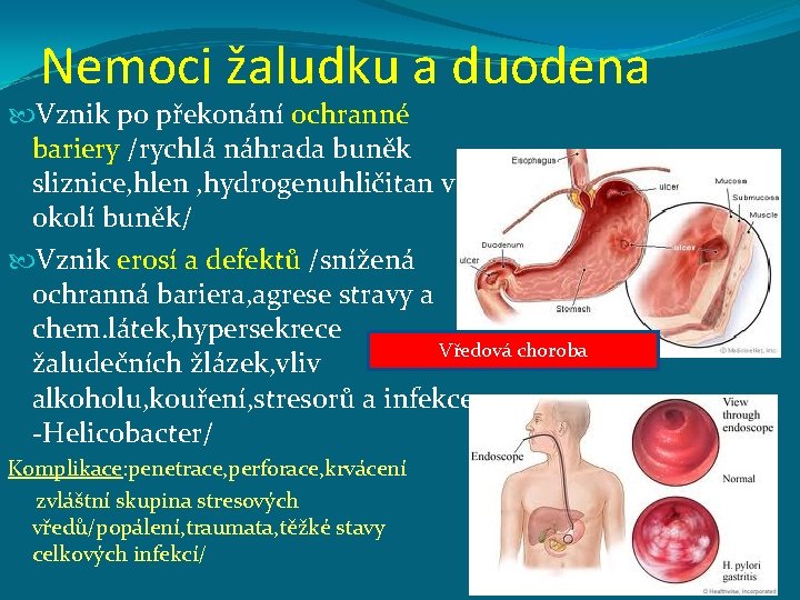 Nemoci žaludku a duodena Vznik po překonání ochranné bariery /rychlá náhrada buněk sliznice, hlen