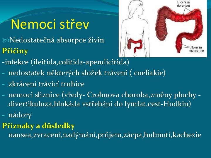 Nemoci střev Nedostatečná absorpce živin Příčiny -infekce (ileitida, colitida-apendicitida) - nedostatek některých složek trávení