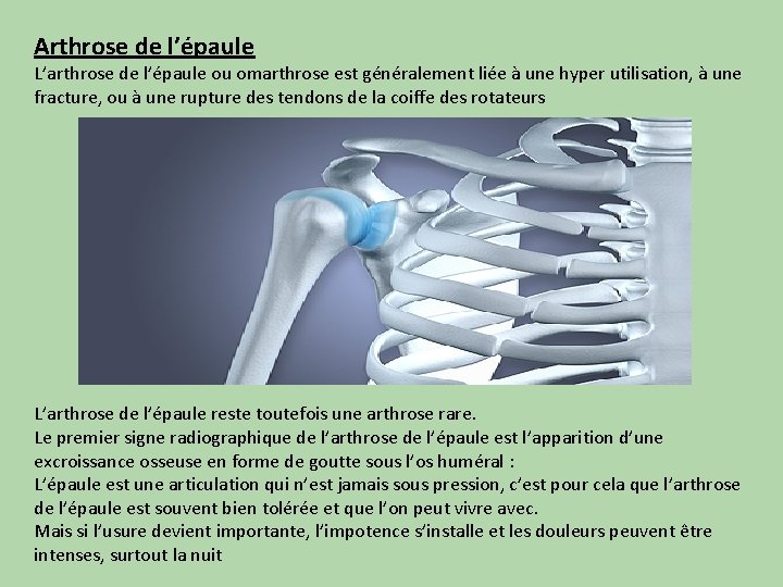 Arthrose de l’épaule L’arthrose de l’épaule ou omarthrose est généralement liée à une hyper