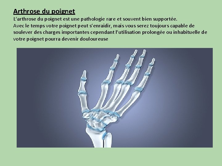 Arthrose du poignet L’arthrose du poignet est une pathologie rare et souvent bien supportée.