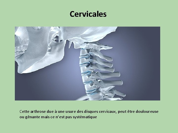 Cervicales Cette arthrose due à une usure des disques cervicaux, peut être douloureuse ou