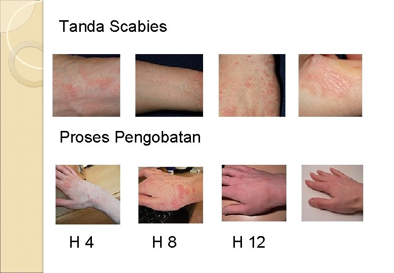 Tanda Scabies Proses Pengobatan H 4 H 8 H 12 