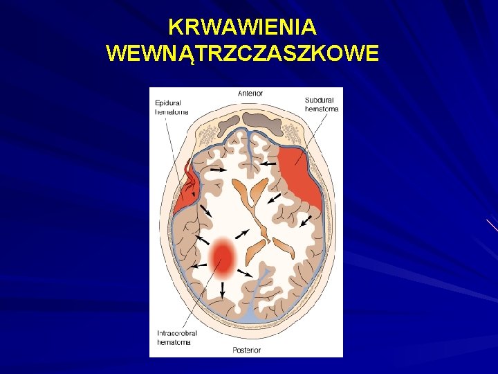 KRWAWIENIA WEWNĄTRZCZASZKOWE 