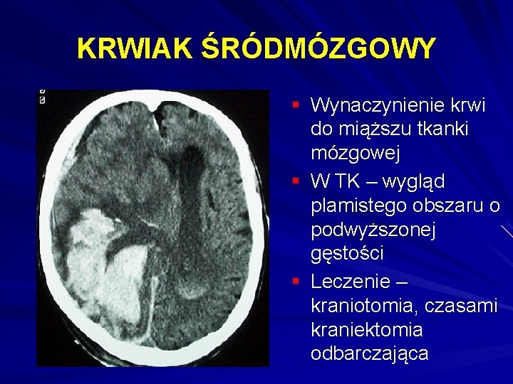 KRWIAK ŚRÓDMÓZGOWY § Wynaczynienie krwi do miąższu tkanki mózgowej § W TK – wygląd