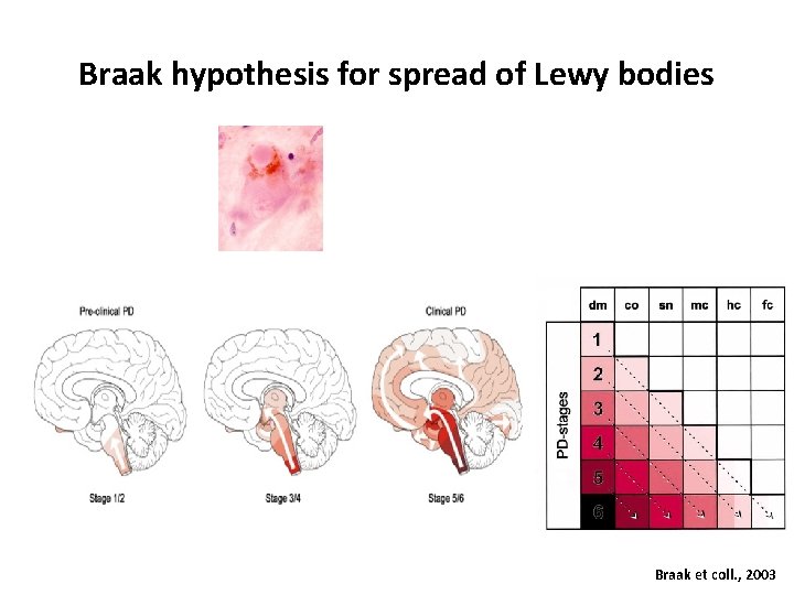 Braak hypothesis for spread of Lewy bodies Braak et coll. , 2003 