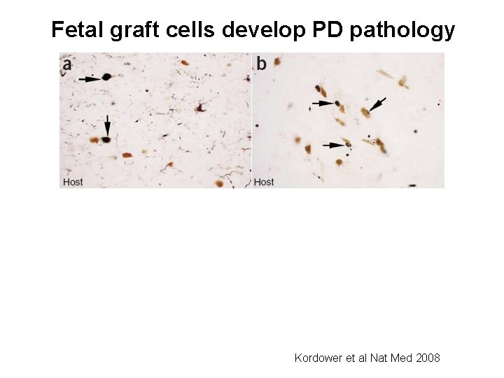 Fetal graft cells develop PD pathology Kordower et al Nat Med 2008 