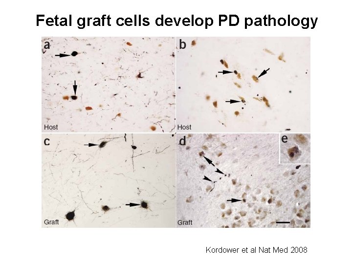 Fetal graft cells develop PD pathology Kordower et al Nat Med 2008 