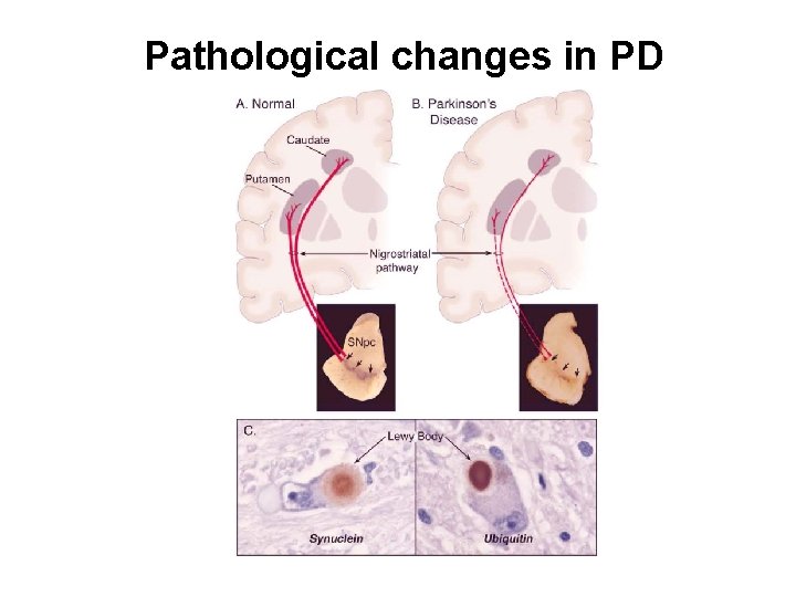 Pathological changes in PD 