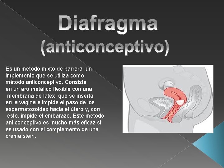 Es un método mixto de barrera , un implemento que se utiliza como método