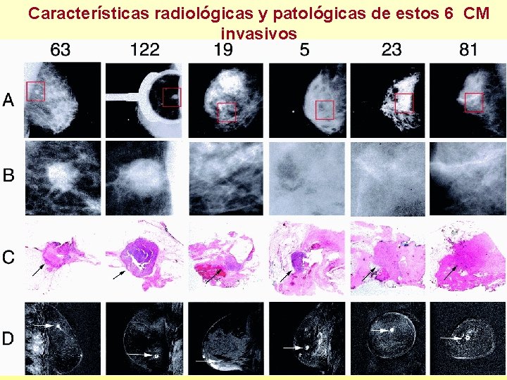 Características radiológicas y patológicas de estos 6 CM invasivos 