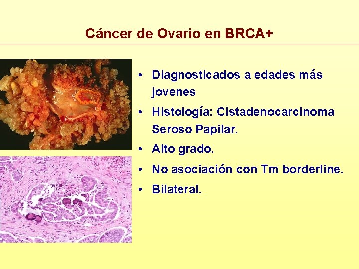 Cáncer de Ovario en BRCA+ • Diagnosticados a edades más jovenes • Histología: Cistadenocarcinoma