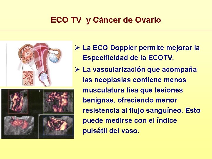 ECO TV y Cáncer de Ovario Ø La ECO Doppler permite mejorar la Especificidad