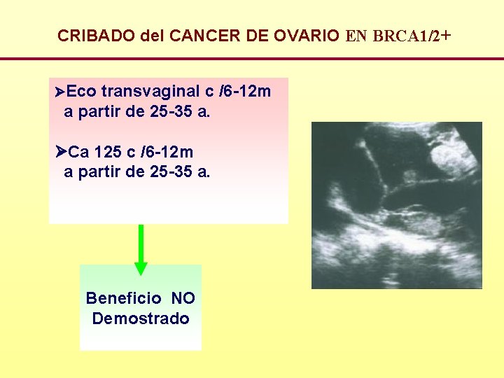 CRIBADO del CANCER DE OVARIO EN BRCA 1/2+ Eco transvaginal c /6 -12 m