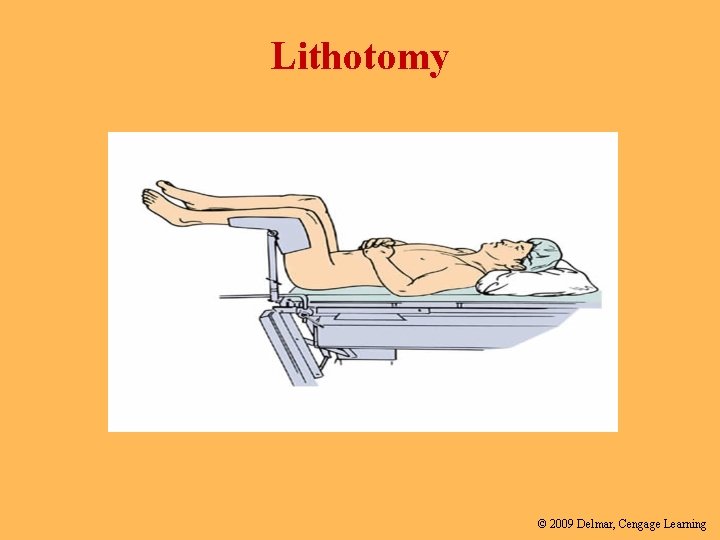 Lithotomy © 2009 Delmar, Cengage Learning 