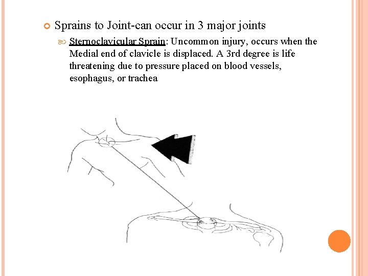 Sprains to Joint-can occur in 3 major joints Sternoclavicular Sprain: Uncommon injury, occurs