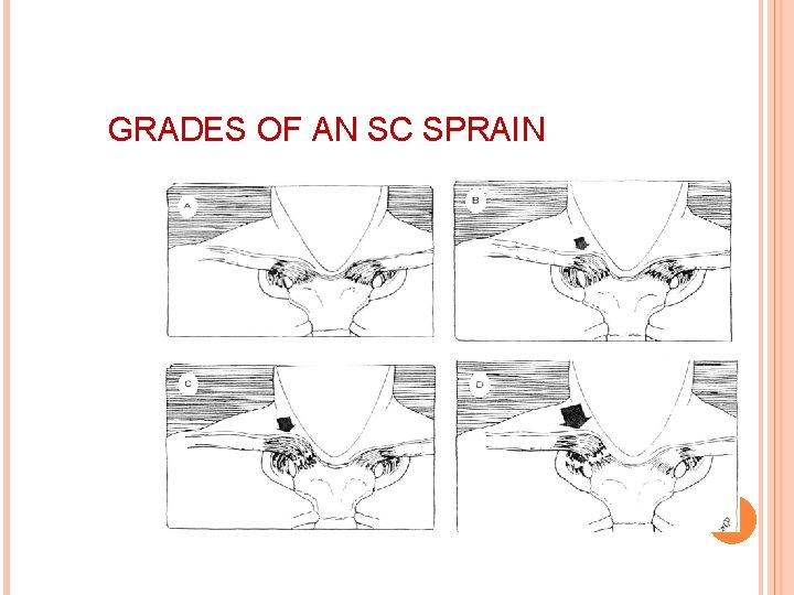 GRADES OF AN SC SPRAIN 