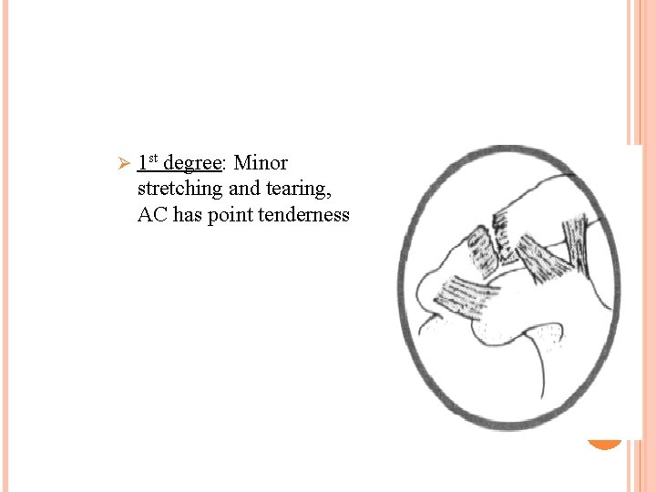 Ø 1 st degree: Minor stretching and tearing, AC has point tenderness 