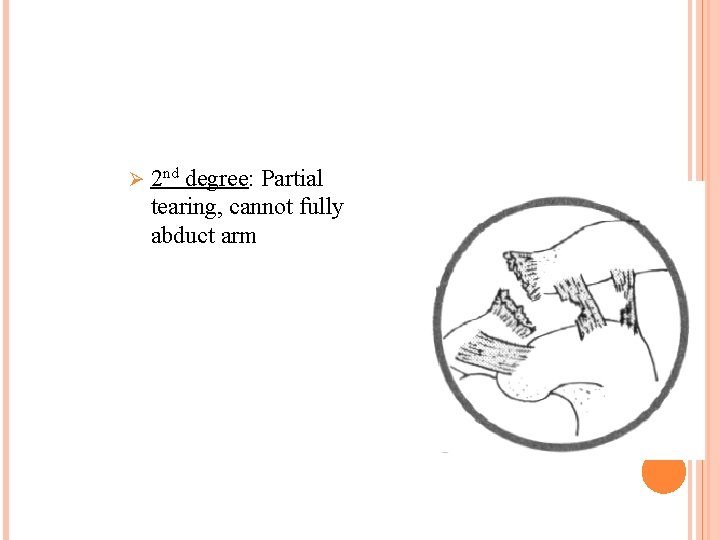 Ø 2 nd degree: Partial tearing, cannot fully abduct arm 