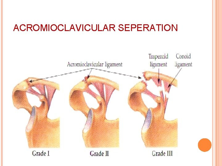 ACROMIOCLAVICULAR SEPERATION 