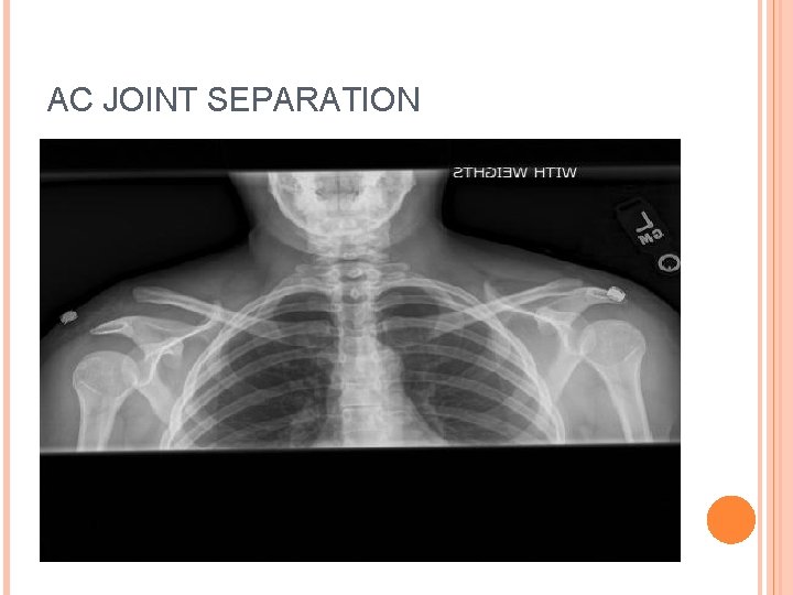 AC JOINT SEPARATION 