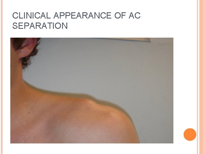 CLINICAL APPEARANCE OF AC SEPARATION 