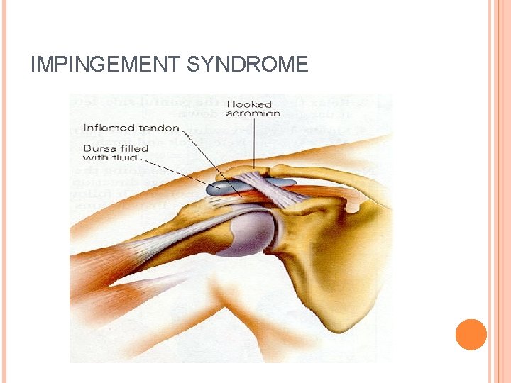 IMPINGEMENT SYNDROME 
