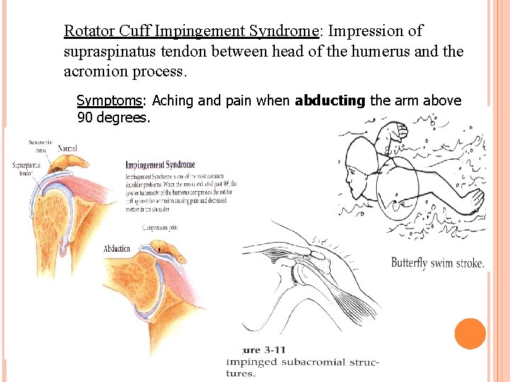 Rotator Cuff Impingement Syndrome: Impression of supraspinatus tendon between head of the humerus and