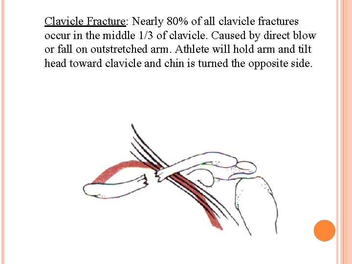 Clavicle Fracture: Nearly 80% of all clavicle fractures occur in the middle 1/3 of