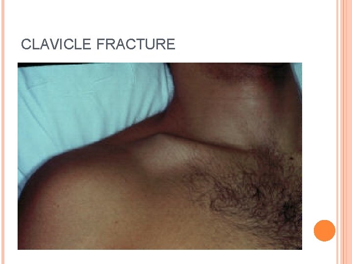 CLAVICLE FRACTURE 