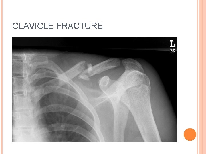 CLAVICLE FRACTURE 