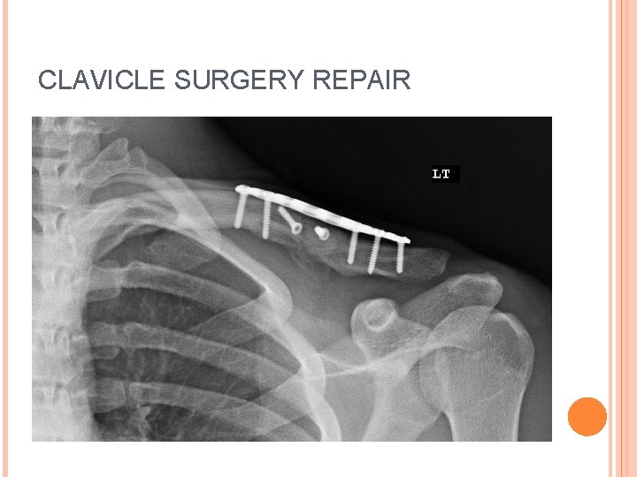 CLAVICLE SURGERY REPAIR 