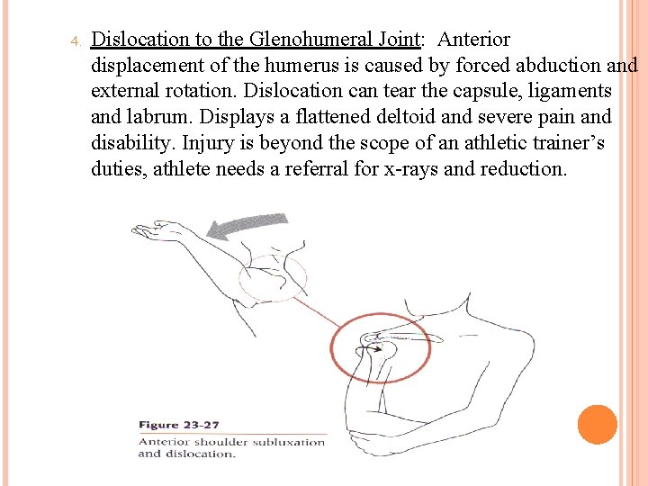 4. Dislocation to the Glenohumeral Joint: Anterior displacement of the humerus is caused by