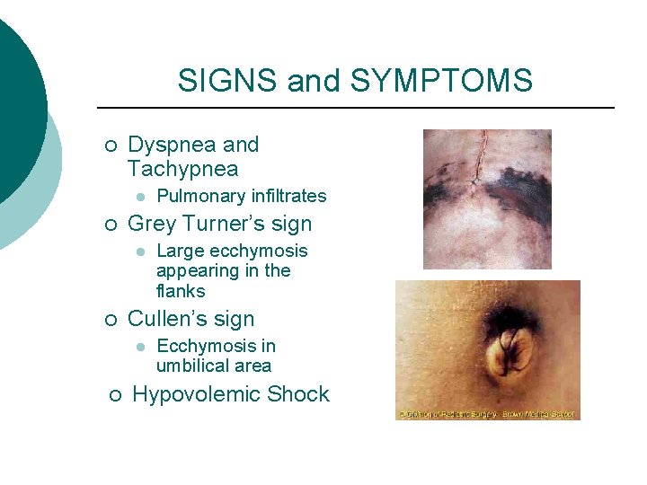 SIGNS and SYMPTOMS ¡ Dyspnea and Tachypnea l ¡ Grey Turner’s sign l ¡