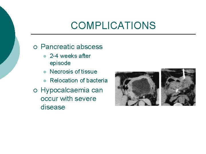 COMPLICATIONS ¡ Pancreatic abscess l l l ¡ 2 -4 weeks after episode Necrosis