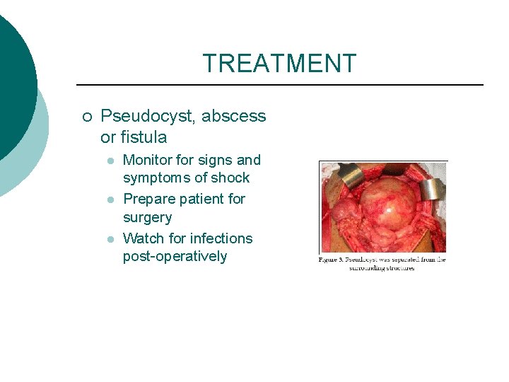 TREATMENT ¡ Pseudocyst, abscess or fistula l l l Monitor for signs and symptoms