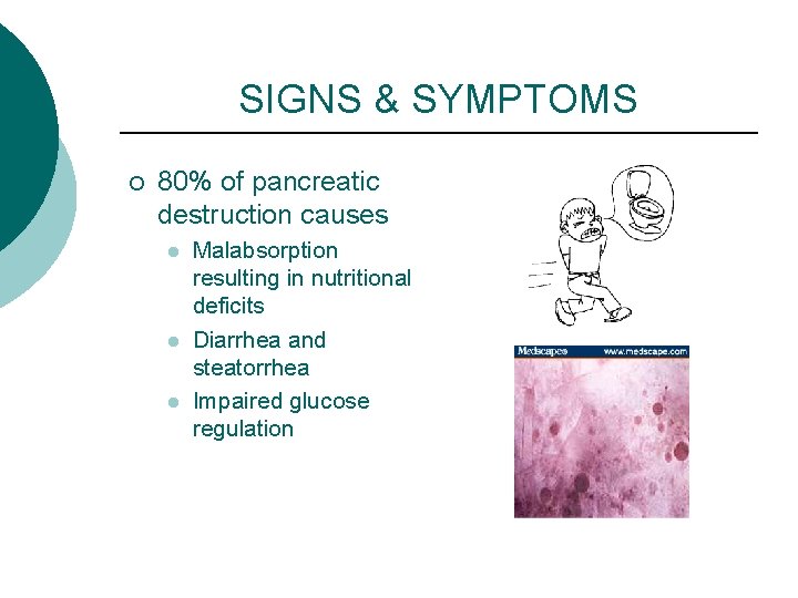 SIGNS & SYMPTOMS ¡ 80% of pancreatic destruction causes l l l Malabsorption resulting