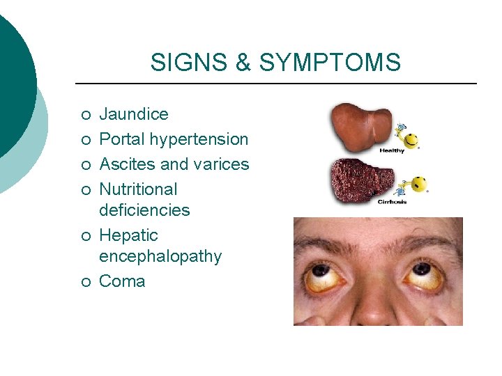 SIGNS & SYMPTOMS ¡ ¡ ¡ Jaundice Portal hypertension Ascites and varices Nutritional deficiencies