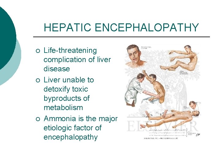 HEPATIC ENCEPHALOPATHY ¡ ¡ ¡ Life-threatening complication of liver disease Liver unable to detoxify