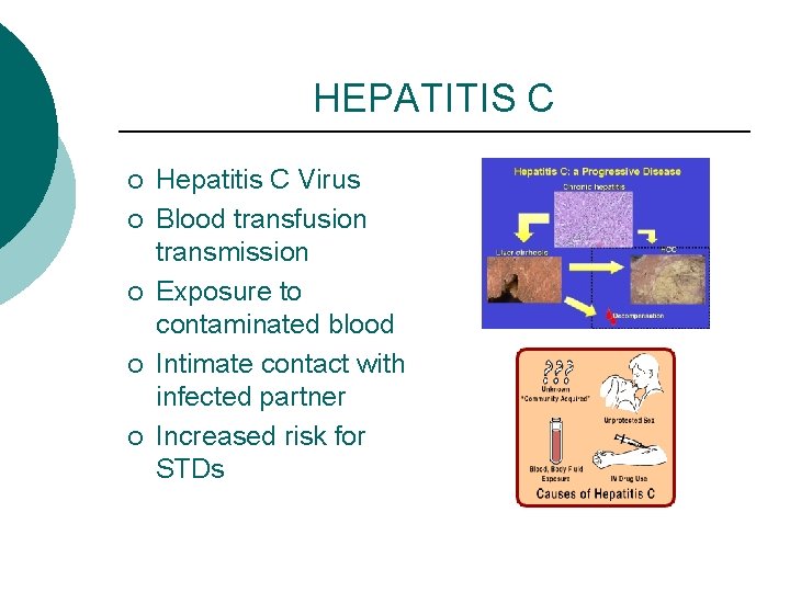HEPATITIS C ¡ ¡ ¡ Hepatitis C Virus Blood transfusion transmission Exposure to contaminated