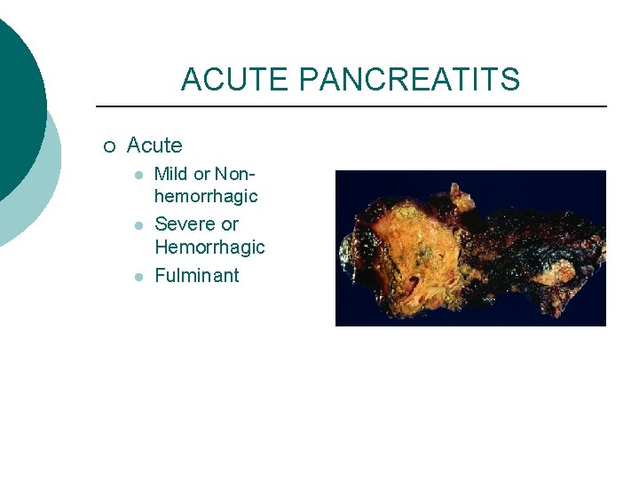 ACUTE PANCREATITS ¡ Acute l l l Mild or Nonhemorrhagic Severe or Hemorrhagic Fulminant