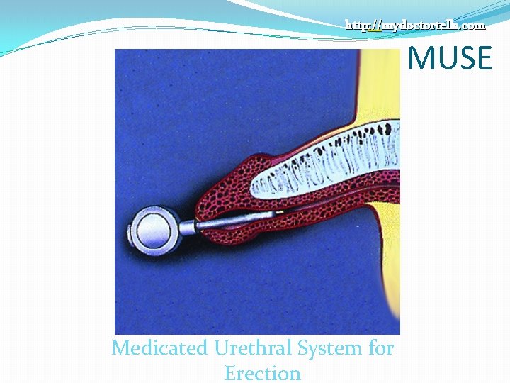 http: //mydoctortells. com MUSE Medicated Urethral System for Erection 