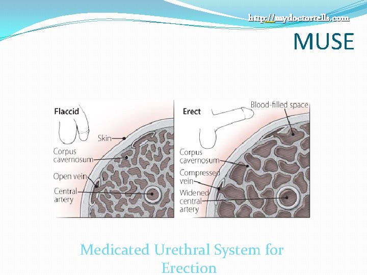 http: //mydoctortells. com MUSE Medicated Urethral System for Erection 