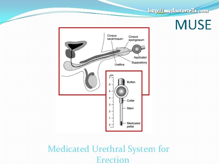 http: //mydoctortells. com MUSE Medicated Urethral System for Erection 