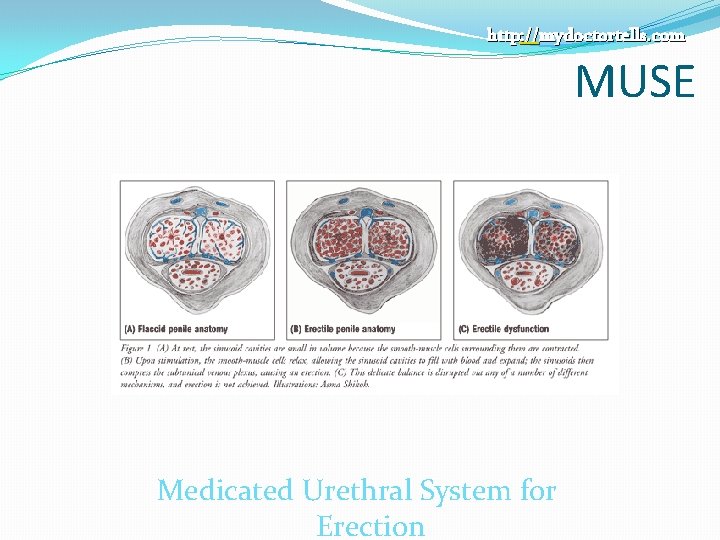 http: //mydoctortells. com MUSE Medicated Urethral System for Erection 