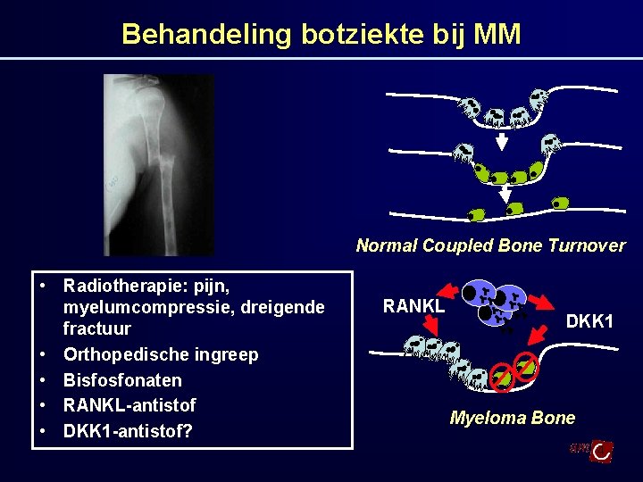 Behandeling botziekte bij MM Normal Coupled Bone Turnover • Radiotherapie: pijn, myelumcompressie, dreigende fractuur